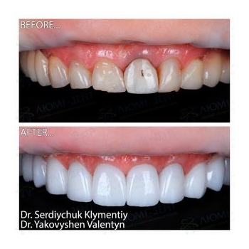 dental implants Kyiv