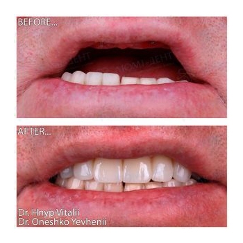 Prosthetics on four Neodent All-on-4 implants