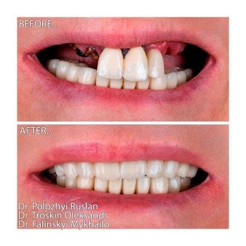 Straumann All-on-6 implantation on the upper jaw