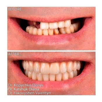 Straumann All-on-6 Implantation for TMJ Dysfunction