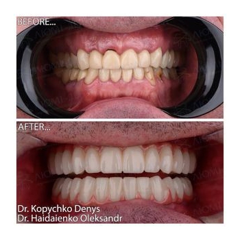 implant prosthetics