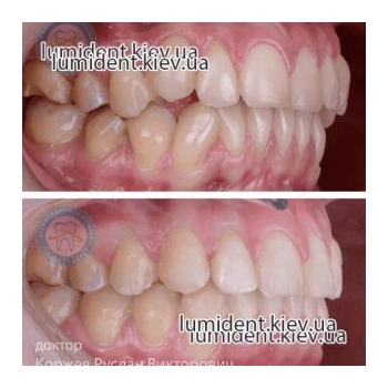 фото до і після виправлення прикусу зубів Люмі-Дент