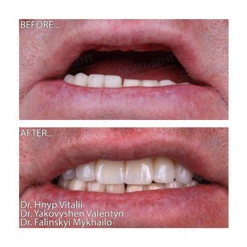 Prosthetics on four Neodent All-on-4 implants