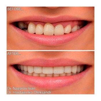 Straumann implants according to the All-on-6 protocol