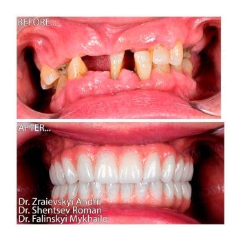 Total rehabilitation of both jaws on Straumann All-on-4 implants