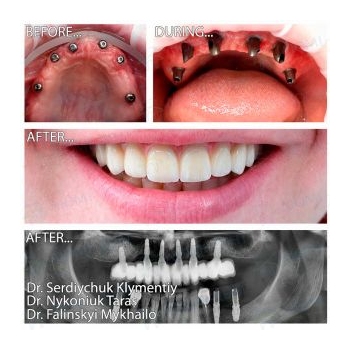Upper jaw restoration with Nobel Biocare implants