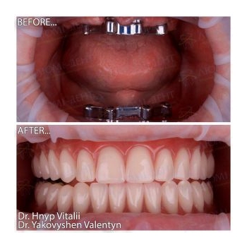 Acrylic overdentures on titanium bars MegaGen AnyRidge