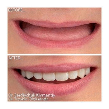 Zirconia dentures on titanium bars All-on-6 Straumann