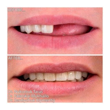 Fixed zirconia prosthetics on All-on-6 implants