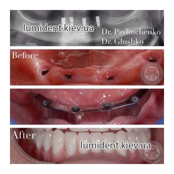 teeth implantation