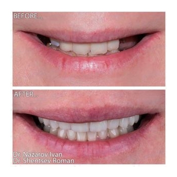 Straumann Implantation and Full-Mouth Rehabilitation