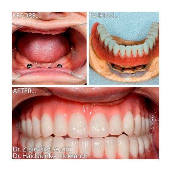 MegaGen AnyRidge implants using the All-on-4 protocol