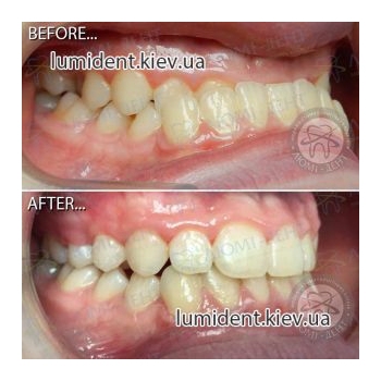 Виправлення прикусу зубів фото Люмі-Дент