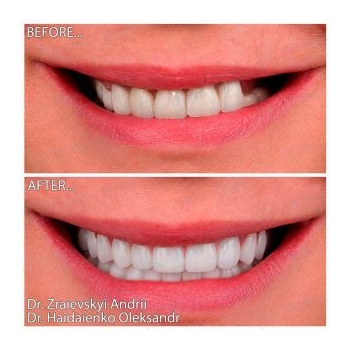 Prosthetics on Straumann implants