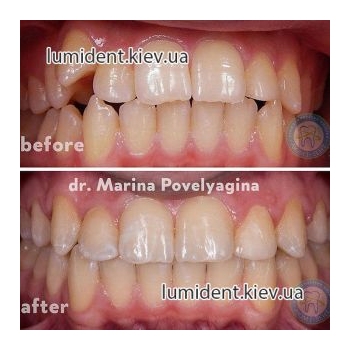 Исправление прикуса Киев фото 