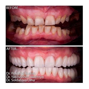 Before and after Straumann smile restoration