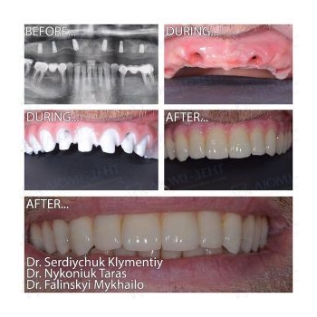 Prosthetics of the upper jaw using the All-on-6 MegaGen AnyRidge method