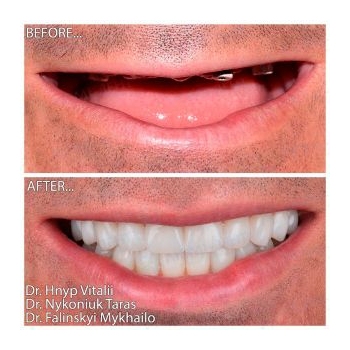 Zirconia Prostheses on a Titanium Bar with the All-on-4 Concept
