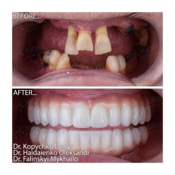 Total rehabilitation of both jaws on Straumann All-on-6 implants