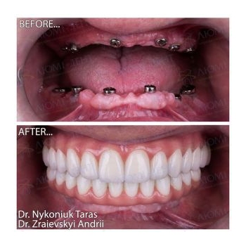 Teeth implantation Lumident