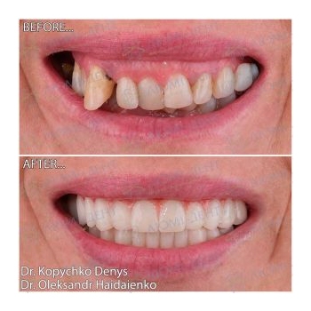 All-on-4 implantation photos by Lumident