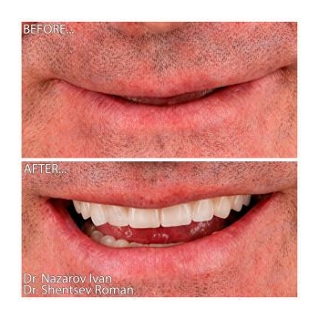 Zirconia dentures on titanium bars All-on-6 Straumann
