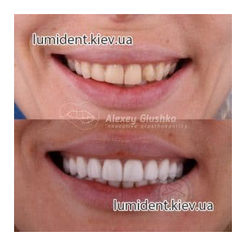 Виниры протезирование зубов Люми-Дент