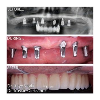 Single-stage dental implantation — Lumident photo