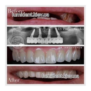 Імплантація протезування зубів фото Люмідент