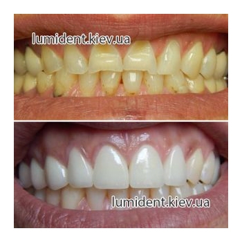 dental prosthesis