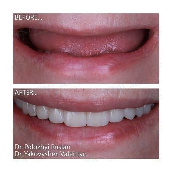before and after implant prosthetics