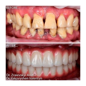 two-stage implant placement Lumident photo