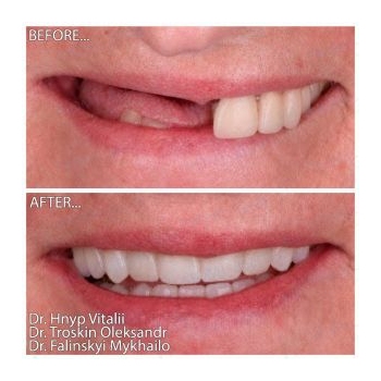 Total dental rehabilitation on Neodent implants