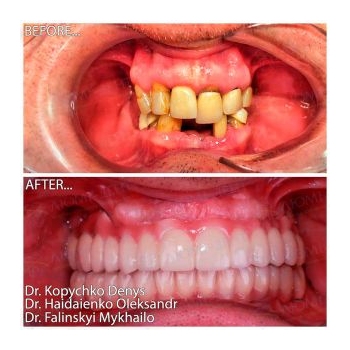 Dental arch restoration with MegaGen implants