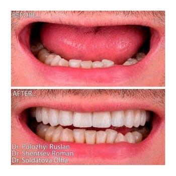 Before and after MegaGen smile restoration