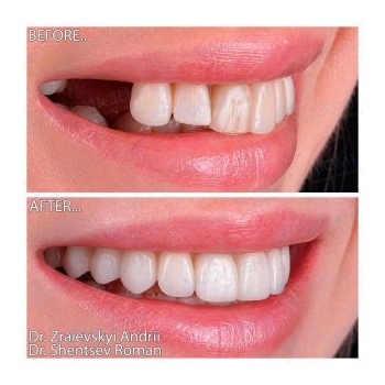 Zirconia crowns on Straumann BLT Roxolid implants