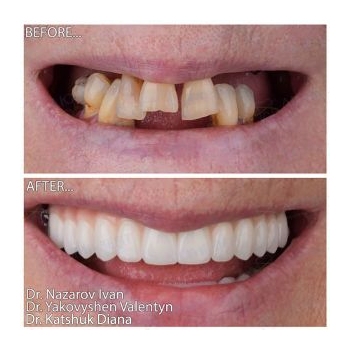 Zirconia dentures on titanium bars All-on-6 Straumann