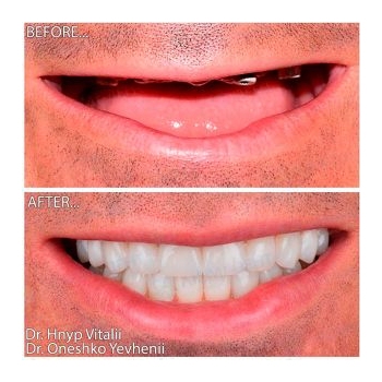 Zirconia Prostheses on a Titanium Bar with the All-on-4 Concept