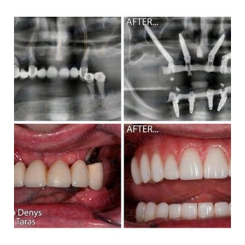 Complete All-on-4 Dental Implant Restoration