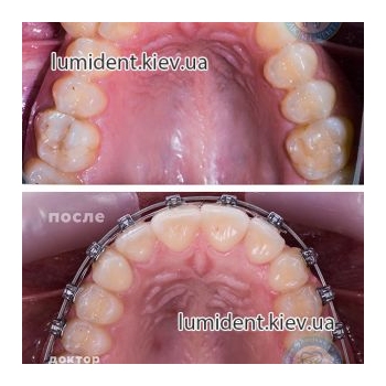 Исправление прикуса зубов фото Люми-Дент