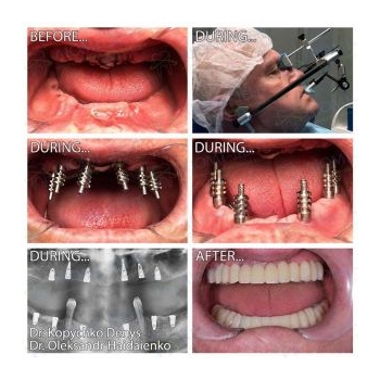 Dental implants Kyiv, before and after photos