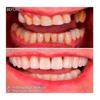 Ceramic veneers and zirconia crowns on Nobel Biocare implants