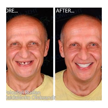 metal-free Lumident implants photo