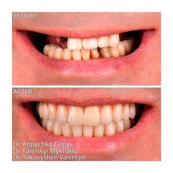 Straumann All-on-6 Implantation for TMJ Dysfunction