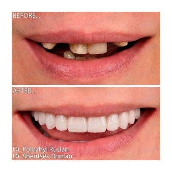 turnkey implantation photo Lumident