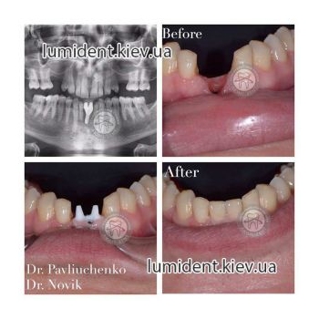 імплантація зубів київ, фото, до і після