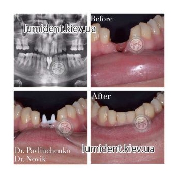 teeth implantation