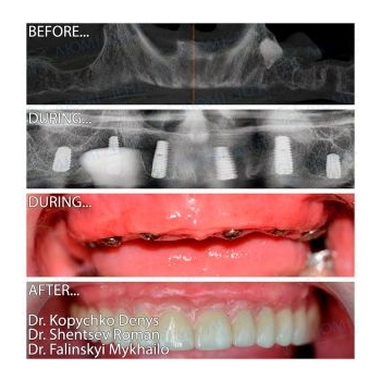 MegaGen All-on-6 Implant Treatment