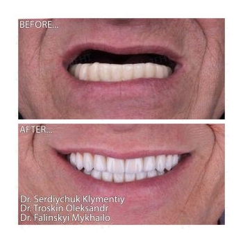 Full-jaw rehabilitation with Neodent implants