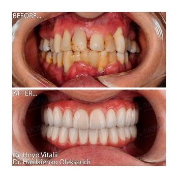 dental implants Kyiv